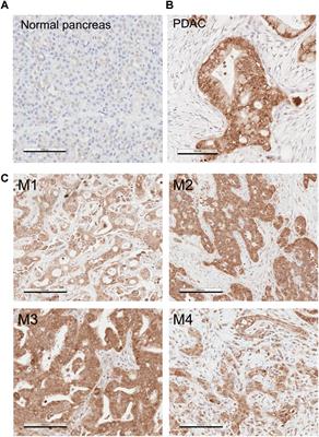 MSP-RON Signaling Is Activated in the Transition From Pancreatic Intraepithelial Neoplasia (PanIN) to Pancreatic Ductal Adenocarcinoma (PDAC)